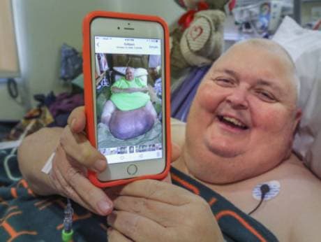 Missisipilik bemordan 58 kilogrammlik o‘simta olib tashlandi