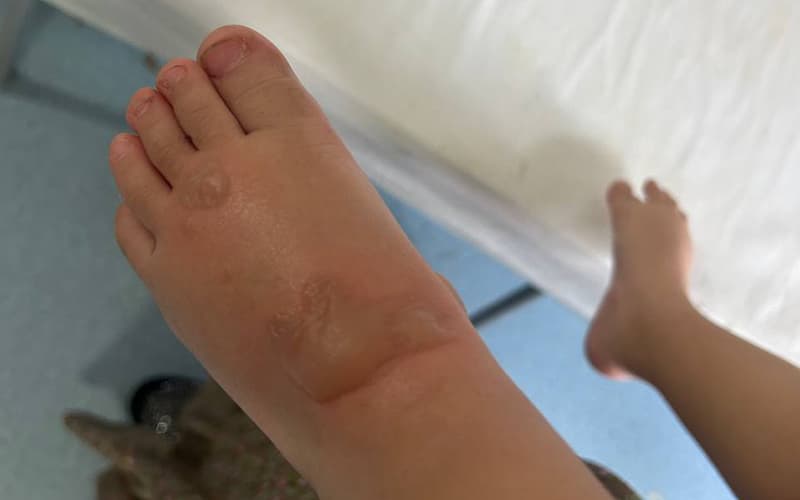 Namanganda oilaviy bog‘cha tarbiyachisi 1,5 yosh bolaning oyog‘ini kuydirib qo‘ygani aytilmoqda