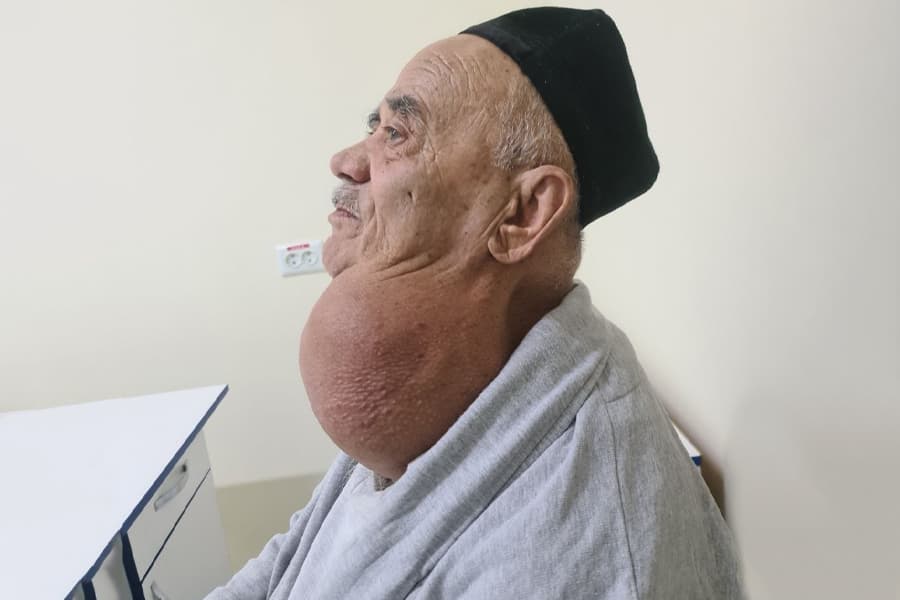 “3 kiloga yetgan”: Samarqandda 80 yoshli bemordagi yirik buqoq olib tashlandi
