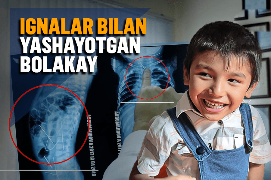 “Tanasida 3 ta igna qoldi” – ignalar bilan yashayotgan bolakay Azizbek 6 yoshga to‘ldi