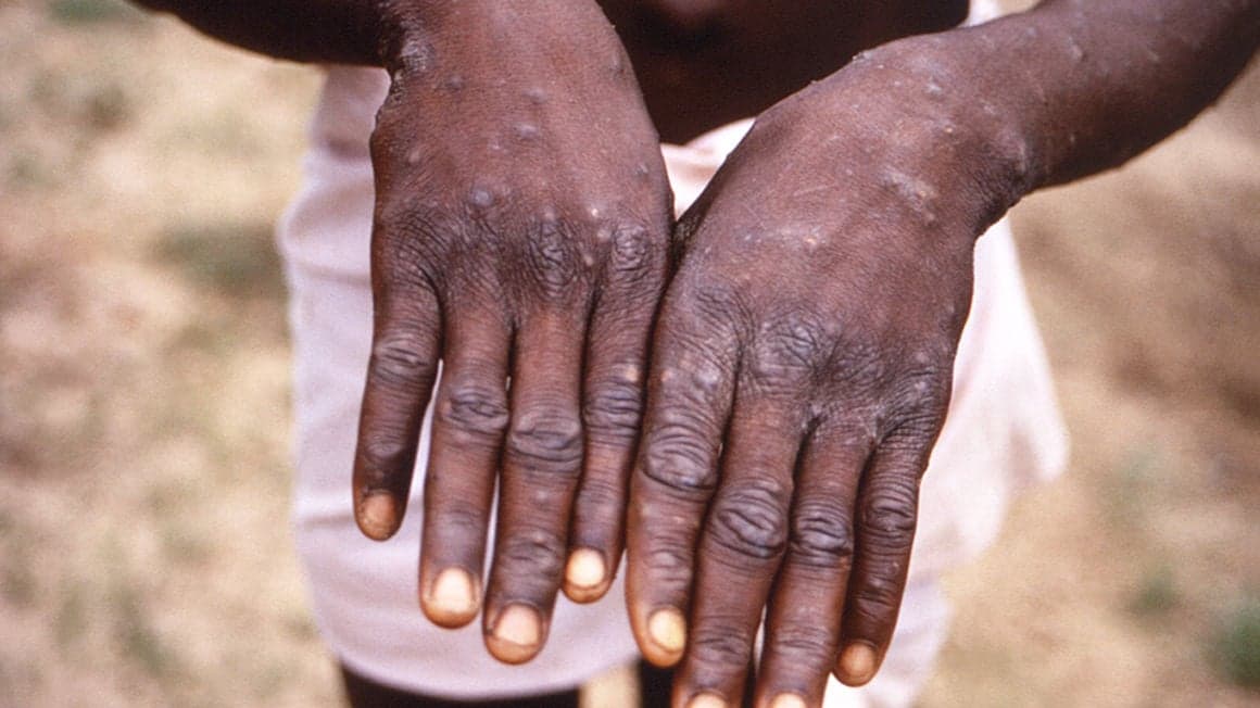 Kongoda maymunchechak epidemiyasi boshlangani e’lon qilindi