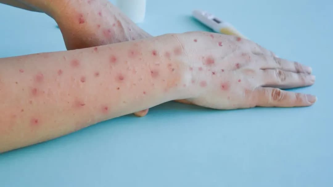 Mpox yangi kovid emas, uni to‘xtata olamiz – JSST