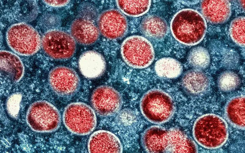 Germaniyada mpox virusining xavfli shtammi bilan kasallanganlar aniqlandi