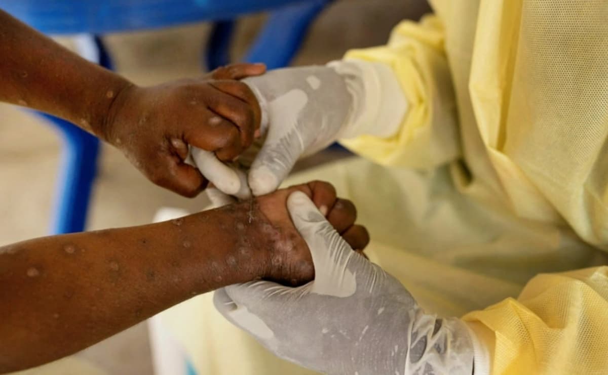 JSST Afrikada mpox epidemiyasiga qarshi kurashishga oid tavsiyalarni tasdiqladi