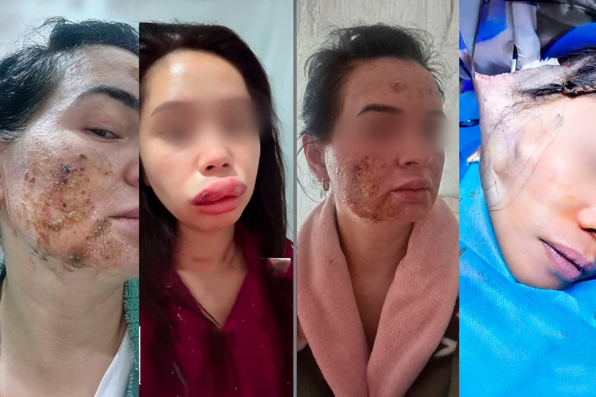 “Operatsiyalarni tibbiy ma’lumotsiz “mutaxassislar” qilyapti” – O‘zbekistonda kosmetologiya nega nazoratsiz?