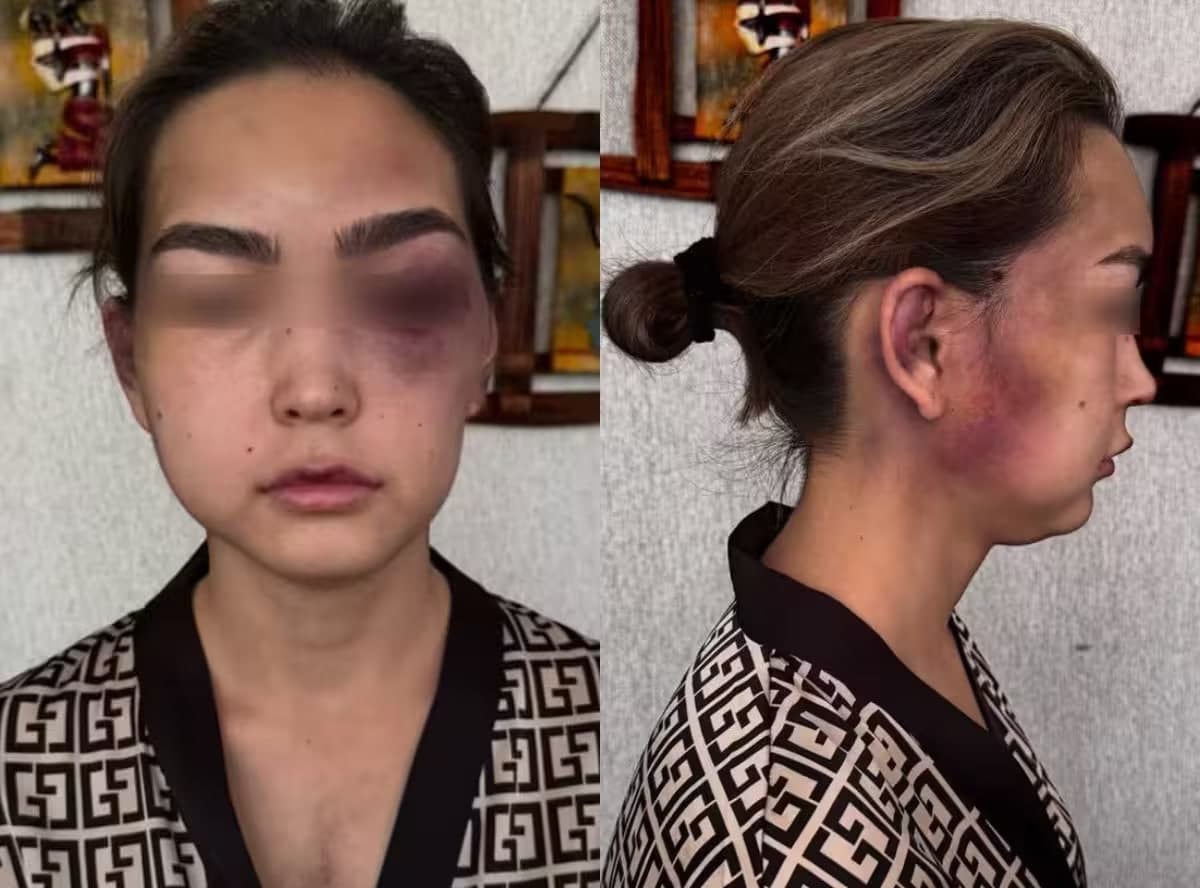 «Pul bermasam, yana uradi» – Surxondaryoda ayol eri tomonidan ayovsiz kaltaklandi