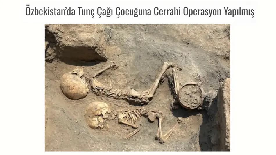O‘zbekistonda 4 ming yillik jarrohlik amaliyoti izlari topildi
