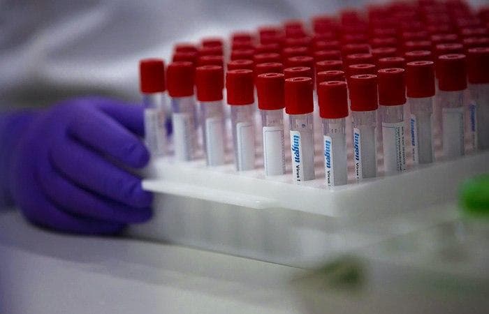 SSV: O‘zbekistonda yana 774 kishi virus yuqtirdi, 835 kishi sog‘aydi. Jami holatlar 25 mingga yaqinlashmoqda