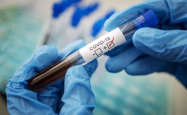 O‘zbekistonda bir kunda 140 dan oshiq kishida koronavirus aniqlandi